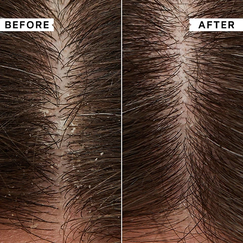 Image 1, before and after. image 2, key benefits. provides, instant relief for itchy, irritated scalps. clears flaking and oil build up. safe for colour treated hair and gentle enough for daily use. image 3, 100% reported it soothed their scalp. 99% reported it cleared their flaky scalp. 95 person independent consumer perception trial all participants suffered with dandruff and itchy scalp. image 4, key ingredients. lauryl betaine - cleanses without redness or irritation. prioctone olamine - antimicrobial to relieve flaking and itching. image 5, this shampoo is excellent for my itchy scalp and it leaves my hair feeling soft with a good shine - customer review. image 6, before and after.
