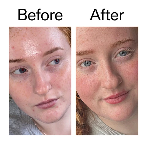 Image 1 - A split image shows a persons face before and after, with the left side displaying skin with visible blemishes and redness, and the right side showing clearer, smoother skin, with the text Before After. Image 2 - A persons hands gently apply a product to their dewy face, covering their eyes and upper cheeks, with visible text that reads: Why we love it. Lightweight, non-greasy, fast-absorbing. Supports healthy looking skin. Daily moisturiser enriched with vitamins, suitable for all skin types. Image 3 - The image shows product information on a light background with a white creamy substance on the right, listing: Why it works Vitamin B3 (Niacinamide) HELPS BALANCE OIL AND REDUCE REDNESS. Vitamin C (SODIUM ASCORBYL PHOSPHATE) BRIGHTENS DULL SKIN AND SUPPORTS RADIANCE. Vitamin E (TOCOPHERYL ACETATE + TOCOPHEROL) ANTIOXIDANT SUPPORT TO HELP SMOOTH AND CALM SKIN. 1% Coconut Oil MOISTURISES AND HELPS FORM A PROTECTIVE BARRIER. Image 4 - A white background with a flowing grey liquid shape details product instructions: How to use USE AM + PM. PEA-SIZED AMOUNT. MASSAGE INTO FACE AND NECK. AFTER CLEANSER AND SERUM, BEFORE SPF IN THE AM. Image 5 - White cream streaks flow across a white background alongside text that reads How to layer your routine and a numbered list: 1 CLEANSE, 2 HYDRATE, 3 TREAT, 4 MOISTURISE, 5 SPF.