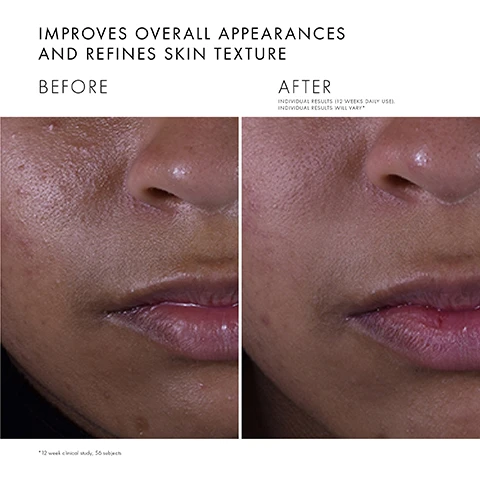 Image 1 - Side-by-side comparison of a face showing skin texture improvement, labeled BEFORE on the left and AFTER on the right, with the text IMPROVES OVERALL APPEARANCES AND REFINES SKIN TEXTURE above and INDIVIDUAL RESULTS (12 WEEKS DAILY USE). INDIVIDUAL RESULTS WILL VARY* below.
Image 2 - An eye dropper dispensing a yellow liquid into a clear dish with small yellow dots, with text listing key ingredients: 15% pure vitamin C, 0.5% silymarin, 0.5% ferulic acid, and 0.5% salicylic acid, along with their benefits.
Image 3 - A dropper releasing a yellow serum is shown above a brown bottle labeled SkinCeuticals Silymarin CF, with text highlighting benefits: Minimises visible pore appearances and refines skin texture, Reduces skin oiliness and appearance of blemishes, Improves clarity, the appearance of fine lines and skin tone evenness.
Image 4 - An image featuring two drops of a clear, yellowish serum against a white background, with text that reads AT A GLANCE, TEXTURE: Oil-free, lightweight serum, and SKIN TYPE: Normal, Oily.
Image 5 - Image shows a skincare regimen with four labeled products for a morning routine: Silymarin CF, Blemish + Age Defense, Daily Moisture, and Oil Shield UV Defense Sunscreen SPF 30, arranged from left to right, with headings for each step including Prevent, Correct, Moisturize, and Protect.
