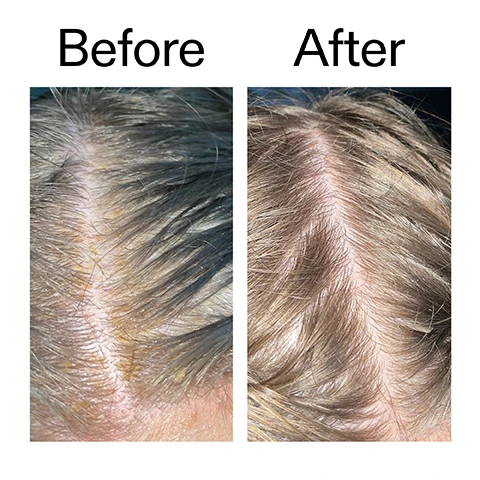 Image 1 - A before and after comparison showing a scalp with severe flaking, redness, and yellowish scales in the before image, transformed to a clean, healthy scalp free of irritation in the after image, with text Before After. Image 2 - Two close-up images show a Before and After comparison of a scalp with dark hair, with the left image displaying visible dandruff flakes and the right image showing a clean scalp with no flakes. Image 3 - A black bottle with a white applicator tip dispenses liquid onto dark hair and scalp, accompanied by the prominent text 100% agree flakes look instantly reduced after 1 use* and a smaller footnote *4-week independent clinical study of 22 people under dermatological control., with partially visible text on the bottle that reads teur de sébum chevelu gras, et pellicules. Image 4 - A persons dark hair and scalp are visible as a black bottle with a white pointed nozzle dispenses liquid onto the hair roots, and the image also contains the text Clinically proven to reduce scalp oiliness and increase hydration levels after 1 use*, 100% agree flakes look instantly reduced after 1 use*, *4-week independent clinical study of 22 people under dermatological control, and partial text on the bottle that reads ENT Serum. Image 5 - Close-up of a persons forehead and blonde hair roots, with text that reads Why we love it, Clears flakes and scalp build-up, Balances oil to help reduce greasy roots, Gentle enough for use on sensitive scalps. Image 6 - A clear liquid with bubbles is spilled on a white background, next to text that reads: Why it works 2% Salicylic Acid EXFOLIATES AND CLEARS FLAKES, OIL, AND BUILDUP. 2.5% Fluidipure™ 8G HELPS CALM SCALP REDNESS AND IRRITATION. 1% Panthenol HYDRATES HAIR AND LOCKS IN MOISTURE. Image 7 - A hand holds a black bottle of The Inkey List Salicylic Acid Exfoliating Scalp Treatment with a white dropper cap, and the image includes the text: How to use USE 1 - 2 TIMES A WEEK. APPLY TO ENTIRE SCALP ON WET OR DRY HAIR. BEFORE SHAMPOO. LEAVE TO WORK FOR 10 MINUTES THEN RINSE WELL. THE INKEY LIST™ 5.0 US FL OZ / 150ml ℮ SALICYLIC ACID EXFOLIATING SCALP TREATMENT Oil and flake control serum Sérum antipellicules régulateur de sébum Best for: oily, itchy and flaky scalps Idéal pour : cuir chevelu gras, démangeaisons, pellicules.