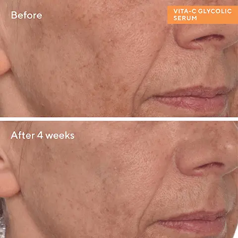 Before. After 4 weeks. VITA-C GLYCOLIC SERUM. ESSENTIAL-C CLEANSER is our vitamin-rich, energising cleanser that washes away impurities without over-drying skin. VITA-C GLYCOLIC SERUM is our gold-stabilised vitamin C and glycolic acid serum for dramatically brighter, healthier-looking skin. ESSENTIAL-C CLEANSER formulated with vitamin-packed beads that deliver a burst of antioxidants with each use. VITA-C GLYCOLIC SERUM 91% of users saw brighter, smoother skin with more glow in 2 weeks. Proven results reported by trial participants in a 2-week clinical study. Cleanse & Brighten Value Kit. 01 Cleanse Essential-C Cleanser Cleanse with Essential-C Cleanser. Pat dry. 02 Treat and Brighten Vita-C Glycolic Serum Apply Vita-C Glycolic Brightening Serum over face, neck + chest.