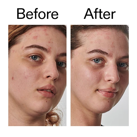 Image 1 - A womans face is shown in a Before and After comparison, with the Before image on the left showing visible acne and redness, and the After image on the right showing significantly clearer skin with reduced blemishes. Image 2 - A close-up of a persons blue eye and hydrated skin below it, with text that reads Clinically proven to deliver 48-hour moisturization after one application* *Independent clinical study of 11 people with dry skin. Image 3 - A close-up of a persons face showing smooth skin around an eye, nose with a stud, and mouth, with accompanying text that reads: Clinically proven to deliver 48-hour moisturization after one application*, 100% of participants showed a significant increase in skin hydration after 24 hours*, Suitable for Eczema and Psoriasis-prone skin**, *Independent clinical study of 11 people with dry skin. **Clinical study of 22 people with Eczema or Psoriasis-prone skin under dermatological control. Image 4 - A close-up of a persons smiling face with clear skin. Text reads: Why we love it. Rich, non-greasy texture. Leaves skin feeling softer and nourished. Gently smooths bumps and flakes without irritation. Image 5 - A creamy white product swatch is shown on the right against a light background, with text on the left explaining Why it works 10% Urea DELIVERS HYDRATION AND EXFOLIATES ROUGH SKIN. 1% Collodial Oat HELPS TO SOOTHE REDNESS. Image 6 - A hand holds a white tube of The Inkey List 10% Urea Moisturizer with the cap off, against a white background, with text that reads How to use, THE INKEY LIST, SUPERSOLUTIONS, 10% UREA MOISTURIZER, 1.7 US fl.oz / 50ml e, Dry and Rough Skin Solution, La Solution contre la Peau Sèche et Rugueuse, USE AM + PM, APPLY PEA-SIZED AMOUNT, MASSAGE INTO FACE AND NECK, OR AFFECTED AREA, AFTER CLEANSER, BEFORE MOISTURISER AND SPF IN THE AM. Image 7 - A white textured background features black text reading How to layer your routine on the left, and on the right, a numbered list that says 1 CLEANSE, 2 HYDRATE, 3 TREAT, 4 MOISTURISE, 5 SPF, with the number 4 encircled.