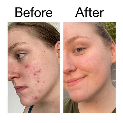 Image 1 - A split image shows a womans face with acne on the left and clear, smiling skin on the right, labeled Before After. Image 2 - A close-up image of a persons face with their hands gently touching their cheeks as they look upwards, accompanied by the text Why we love it, Lightweight and fast-absorbing, 10% Glycolic Acid for deep exfoliation, Unclogs pores for a smoother, radiant complexion. Image 3 - The image shows clear liquid drops on a white background, with text explaining Why it works, 10% Glycolic acid BOOSTS CELL TURNOVER AND EXFOLIATES FOR SMOOTHER, BRIGHTER SKIN, and 5% Witch Hazel HELPS CONTROL OIL AND CALM SKIN. Image 4 - A close-up of a finger with a clear, viscous liquid product dripping from it, illustrating its consistency, next to text providing instructions: How to use USE PM ONLY. 1 - 2 DROPS. PAT INTO FACE AND NECK. AFTER CLEANSER, BEFORE MOISTURISER. ALWAYS APPLY SPF IN THE AM. START 2-3 TIMES A WEEK, GRADUALLY BUILD UP TO DAILY USE. Image 5 - A white background with clear liquid droplets displays the text How to layer your routine and a numbered list: 1 CLEANSE, 2 HYDRATE, 3 TREAT with the number 3 highlighted in a black circle, 4 MOISTURISE, 5 SPF.