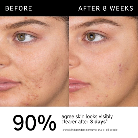 Image 1 - Image shows a close-up of a womans face split into two halves; the left side labeled Before shows visible skin blemishes and imperfections, while the right side labeled After 8 Weeks displays clearer skin; the lower part of the image includes the text 90% agree skin looks visibly clearer after 3 days and a note about a 4-week independent consumer trial of 66 people.
Image 2 - A bottle of salicylic acid cleanser from The Inkey List is shown with bubbles around it, and the text beside it states that it is clinically proven to visibly reduce acne blemishes and blackheads, helps minimize excess oil, and is non-drying, non-stripping, and non-irritating.
Image 3 - A smiling young woman with braided hair on the left side is partially visible, while the text on the right lists percentages: 90% agree skin looks visibly clearer after 3 days, 93% agree skin instantly looks and feels less oily, 92% agree skin did not feel tight or stripped, with a note about a consumer trial of 66 people.
Image 4 - Image shows a close-up view of a clear, bubbly liquid with text overlaid that reads: Ingredients 2% SALICYLIC ACID Works deep within pores to help unclog and gently exfoliate 0.5% ALLANTOIN Helps soothe and comfort skin ZINC COMPOUND Helps reduce excess oil.
Image 5 - A close-up image of a young person washing their face, with text that reads FAQ, CAN I USE THIS DAILY? Yes, for best results use AM and PM daily. For sensitive, blemish-prone, or dehydrated skin, use 2 - 3 times per week. CAN I USE ON MY BODY? Yes, you can use Salicylic Acid Cleanser on other blemish-prone areas, including the back and chest.
Image 6 - An abstract droplet of clear liquid is shown on a light background, with the text How to layer your routine above and numbered steps 1 to 5 labeled as Clean, Hydrate, Treat, Moisturize, and SPF below.
Image 7 - A hand holding a bottle of salicylic acid cleanser with a plain white background, alongside icons representing morning and night application with the text When to apply AM PM.