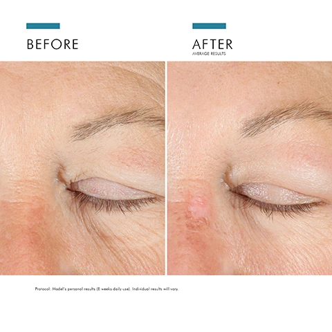 Image 1 - Image shows a close-up of a persons eyes, with the left side labeled BEFORE showing wrinkles and texture differences around the eyelid, and the right side labeled AFTER showing a smoother, more refined skin texture; the visible text at the bottom reads Models personal results (8 weeks daily use). Individual results will vary.
Image 2 - Image of a skincare product with a jar of SkinCeuticals A.G.E. Advanced Eye cream next to a swirl of cream, featuring text that reads Clinically Proven Results, Visible Results after first application, and 92% of women agree skin looks firmer and brighter, with a note about the study details.
Image 3 - A close-up of an eye with a light cream being applied to the skin underneath, accompanied by a text box stating Reduces the appearance of crow’s feet lines and dark circles.
Image 4 - An image of a creamy skincare product in a clear dish with labels pointing to its key ingredients, which include concentrated proxyline, concentrated flavonoid blend, Matrixyl 3000, and glycyrrhetinic acid.
Image 5 - Image shows a two-step guide for applying SkinCeuticals A.G.E. Advanced Eye cream, with the first step featuring a person holding a jar of cream and the second step depicting the application of the cream around the eye area; visible text includes HOW TO APPLY, STEP 1: Using clean hands, gently press into the jar to pick up a small amount of product, STEP 2: Dab cream along the eye area, following the natural curve of the cheekbone and browbone. Do not apply directly to eyelids.
Image 6 - Image shows a side-by-side comparison of two eye treatments: a jar labeled A.G.E. ADVANCED EYE and a bottle labeled AOX+ EYE GEL, with a table listing concerns, skin types, and benefits; text visible includes EYE TREATMENT COMPARISON, CONCERN, SKIN TYPE, and BENEFIT.
Image 7 - A series of four skincare products arranged horizontally, labeled STEP 1 PREVENT for C E Ferulic, STEP 2 CORRECT for A.G.E. Advanced Eye, STEP 3 CORRECT for A.G.E. Interrupter Advanced, and STEP 4 PROTECT for Mineral Eye UV Defense SPF 30, with product images beneath each label.
Image 8 - An infographic showing a nighttime skincare regimen with four steps labeled Prevent, Correct, and the products Resveratrol B E, H.A. Intensifier, A.G.E. Advanced Eye, and A.G.E. Interrupter Advanced.