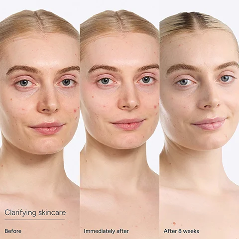 comparison shows a womans face with acne and redness, then immediately after, and finally after 8 weeks of using clarifying skincare, with visible improvement in skin clarity, accompanied by the text Clarifying skincare, Before, Immediately after, After 8 weeks.