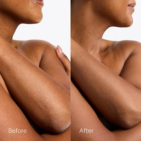 Image 4 - A split image showing a persons upper arm, elbow, and neck area with bumpy skin on the left and visibly smoother skin on the right, labeled Before and After.